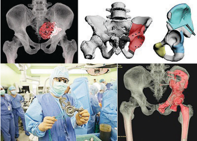 3D 프린팅 맞춤형 임플란트를 이용한 골반골 재건 수술/ 자료=국립암센터