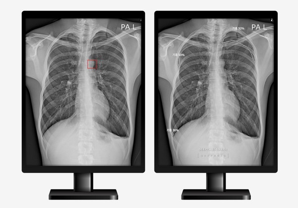 (왼쪽)원본 이미지와 AI기반 의료기기를 통한 예측 결과가 적용된 이미지 비교