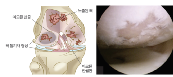 퇴행성 무릎 관절염의 모식도(좌) 및 관절경 소견(우)