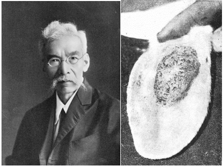의사 야마기와 카츠사부로山極 勝三郎 (좌) 및 토끼 귀 피부암(우, 癌 1914 )