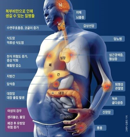 그림 G. 비만으로 인해 생길 수 있는 질환 [그림출처; 조선일보]