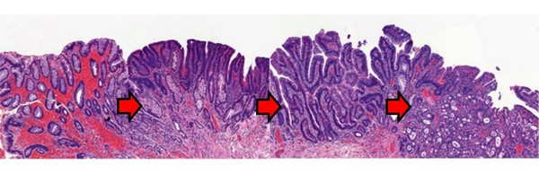 그림 E. (왼쪽에서 오른쪽으로) 바렛식도가 식도암으로 진행되면서 점점 변성되고 손상되는 세포 [그림출처: 대한소화기학회].