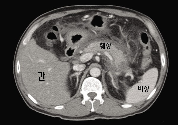그림 B. 급성췌장염 환자의 복부 CT