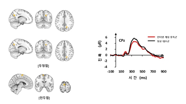 기능적 MRI 검사 결과 인터넷 게임 중독군은 정상대조군들보다 두정엽과 전두엽 부위에서 뇌 활성이 증가했다(왼쪽 사진). 청각 자극에 대한 뇌파 신호의 진폭은 인터넷 게임 중독군이 정상대조군보다 감소했다(오른쪽 그래프).