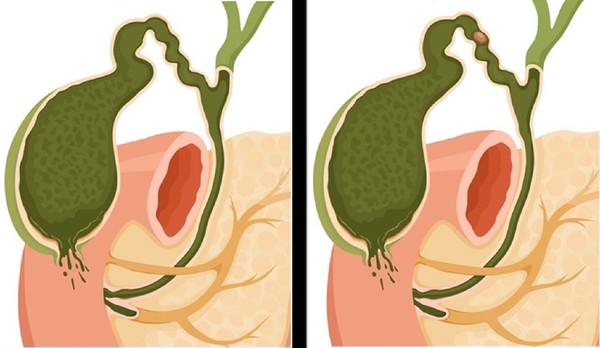 무결석성 담낭염(왼쪽)과 결석성 담낭염 모식도