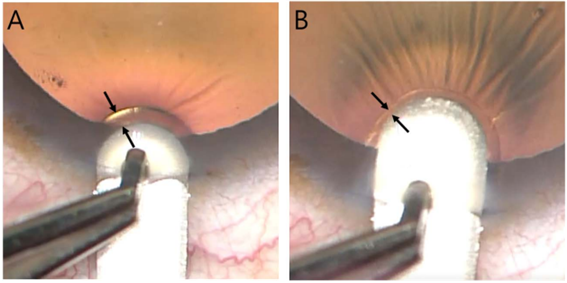 망막반사를 이용한 앞부분층 각막이식 수술 장면