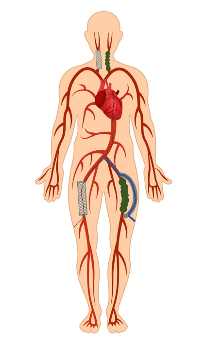 인조혈관 경유 타비시술을 받은 환자의 혈관 상태. 우측 대퇴동맥과 우측 경동맥에 스텐트가 삽입돼 있고, 좌측 대퇴동맥과 좌측 경동맥은 심한 협착으로 폐쇄된 상태다. 좌측 대퇴동맥에 연결된 인조혈관을 경유해 타비시술이 이뤄졌다.
