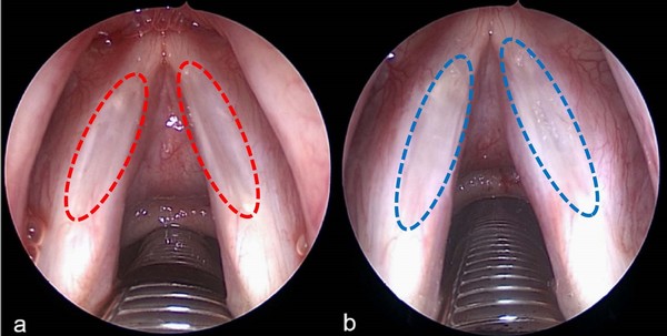 (좌측) 양측 성대의 점막이 안쪽으로 들러붙은 성대구증 환자의 수술 전 내시경 소견 (우측) 532nm 레이저를 이용한 성대구증 레이저 성대성형술 시행 직후의 내시경 소견