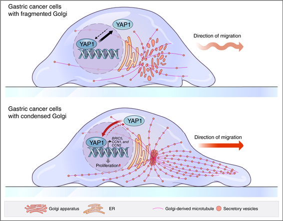위암 세포 내 골지체의 응축된 구조 변형이 암 촉진 인자인 YAP1을 활성화시켜 암의 악성화를 유도하는 과정을 설명하는 모식도